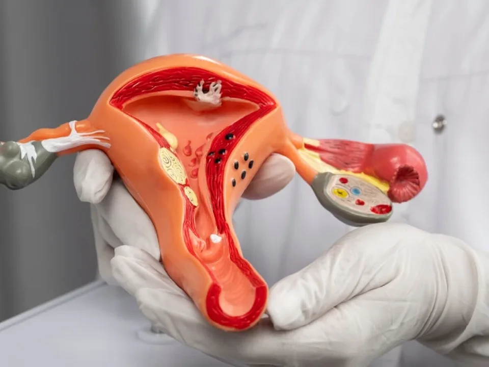 Chirurgie des fibromes